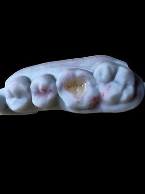 comprar Dental natural translúcido todo de cerámica Emax Onlay para la restauración dental Fabricación en línea