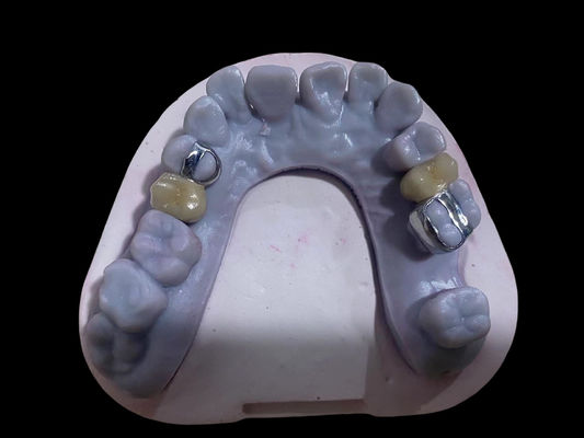 comprar Coronas de porcelana de metal libre de aleación dental de corona PFM de alta precisión Fabricación en línea