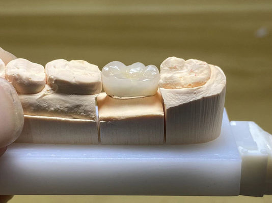 comprar Resistencia a las manchas PFM Corona de cerámica ajustable con forma natural del diente Fabricación en línea