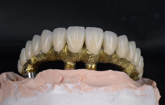 comprar Implantes dentales y coronas de aleación de titanio de aspecto natural y resistentes a la corrosión Fabricación en línea