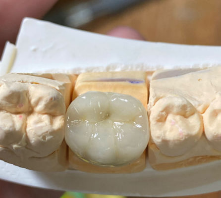 comprar Precisión estética Dental fuerte PFM porcelana fundida a la corona de metal en odontología Fabricación en línea