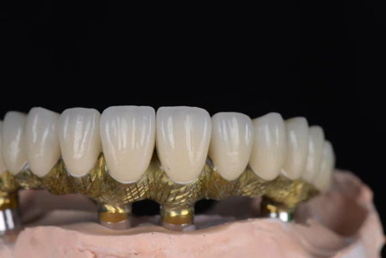 comprar Porcelana de corona de aspecto natural fusionada con metal de alta precisión para implantes dentales Fabricación en línea