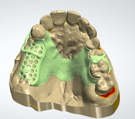 comprar Marco digital de metal CAD CAM Diseño dental Material de cocción con impresión 3D Fabricación en línea