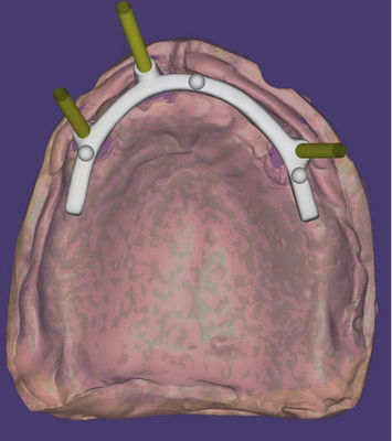 comprar Diseño CAD CAM Dental personalizado de alta precisión para barra con apoyo de implantes Fabricación en línea