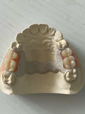 comprar Dental PEEK de acrílico parcial personalizado Dentadura ajustable con ajuste seguro Fabricación en línea