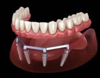 comprar Barras de implantes dentales de arena para una estética translúcida y natural Fabricación en línea