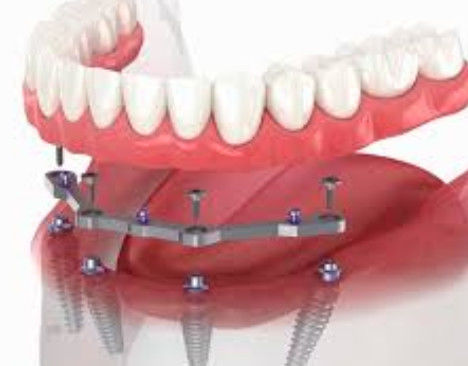 comprar Barras dentales de titanio fresadas de arco completo de 12 mm de longitud con más de 2 accesorios Fabricación en línea