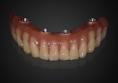 Implante dental personalizado de reemplazo de corona resistente al desgaste para uso a largo plazo