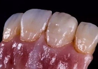 Alemana Amanjilbach Zirconia corona dental de alta densidad con personalización