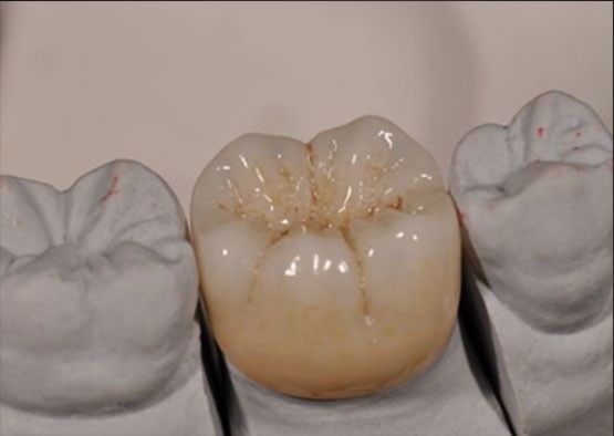 Alta estética Noritake Zirconia color natural estable para la corona completa de zirconia