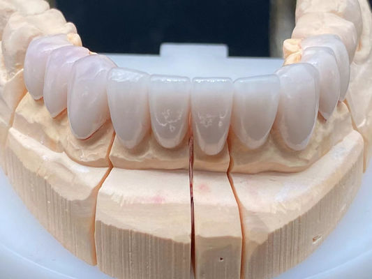 Laboratorio Dental E Max Corona cerámica de alta transparencia con resistencia a la corrosión