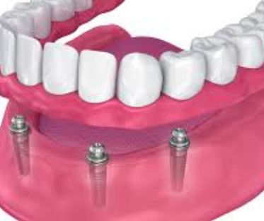 Apego de bola de implante personalizable de larga duración para implantes retenidos