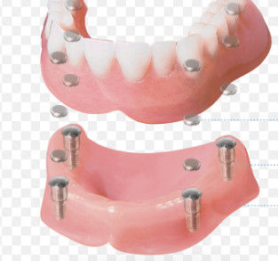 Aplicación de alta precisión para el dentista con pegamento magnético de la superficie, pulido y personalizable