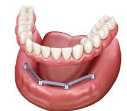 Barras de implante translúcidas retenidas por tornillo Dentadura de superficie pulida Barras de implante