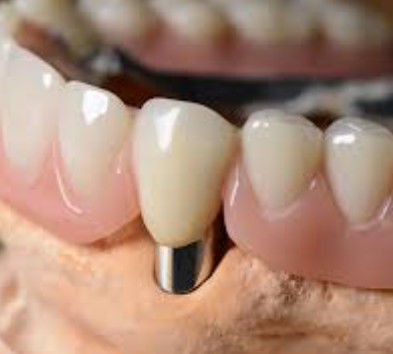 Corona dental telescópica personalizable de alta precisión con aspecto natural