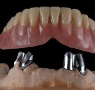 Coronas telescópicas confortables y de fácil mantenimiento personalizadas para la restauración dental